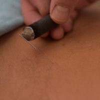 Moxa hilft bei Kälte erkrankungen und heilt Schmerzen